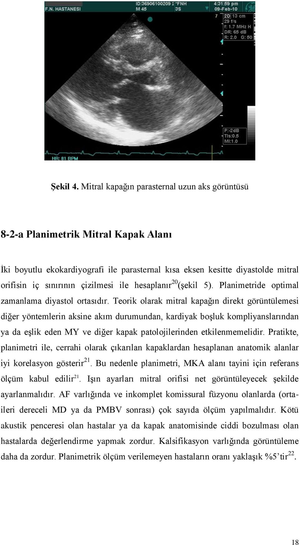 hesaplanır 20 (şekil 5). Planimetride optimal zamanlama diyastol ortasıdır.