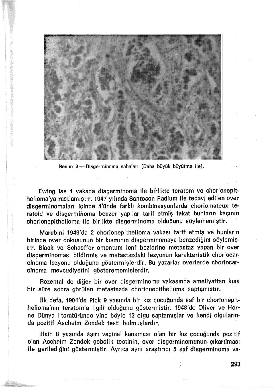 chorlonepithelioma ile birlikte disgerminoma olduğunu söylememiştir.