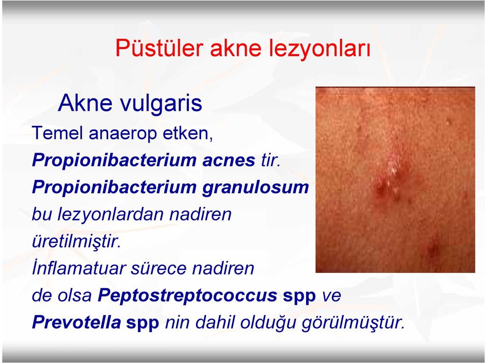 Propionibacterium granulosum bu lezyonlardan nadiren üretilmiştir.