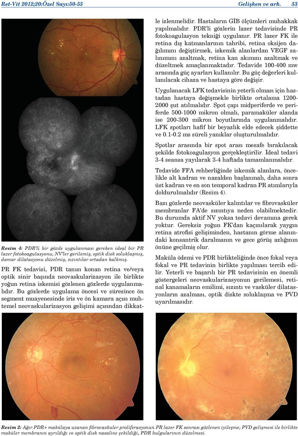 PR FK tedavisi, PDR tanısı konan retina ve/veya optik sinir başında neovaskularizasyon ile birlikte yoğun retina iskemisi gözlenen gözlerde uygulanmalıdır.