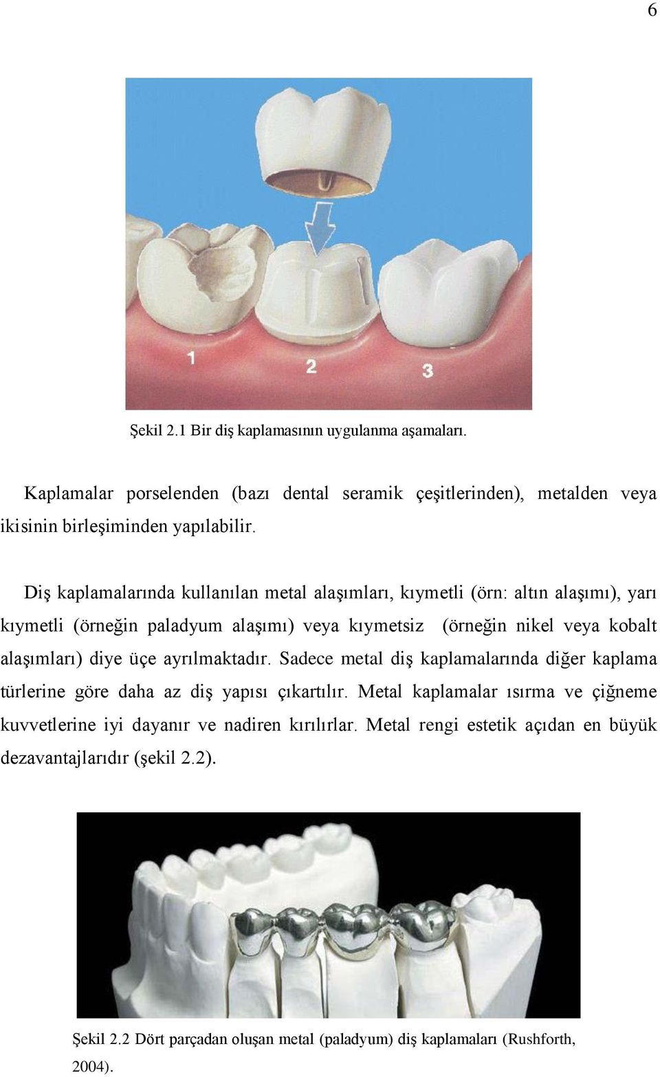 alaşımları) diye üçe ayrılmaktadır. Sadece metal diş kaplamalarında diğer kaplama türlerine göre daha az diş yapısı çıkartılır.