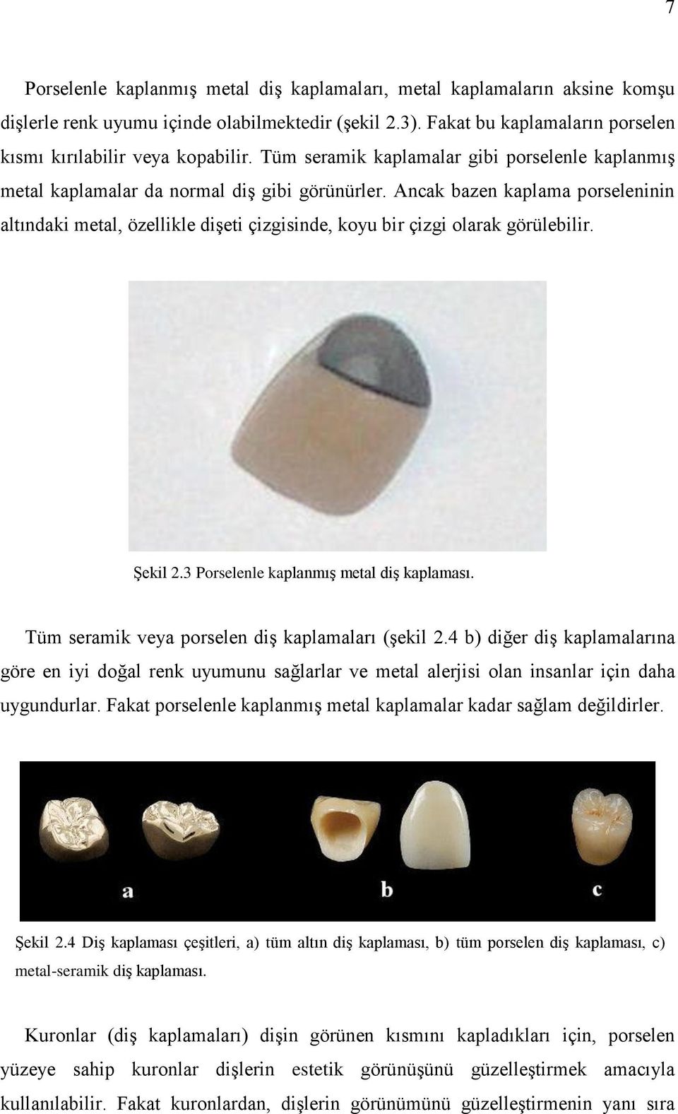 Ancak bazen kaplama porseleninin altındaki metal, özellikle dişeti çizgisinde, koyu bir çizgi olarak görülebilir. Şekil 2.3 Porselenle kaplanmış metal diş kaplaması.