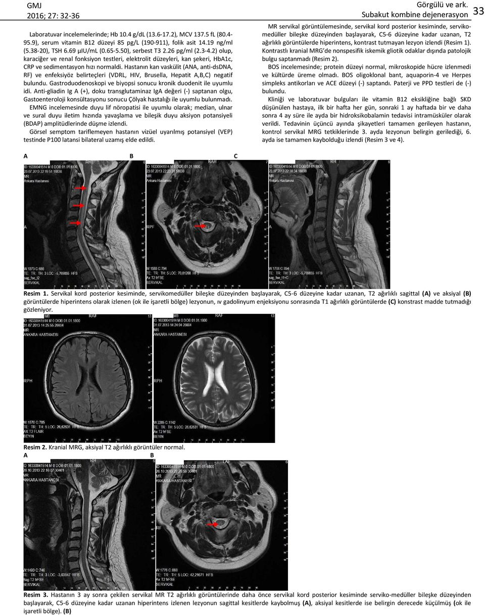 Hastanın kan vaskülit (N, anti-dsdn, RF) ve enfeksiyöz belirteçleri (VDRL, HIV, rusella, Hepatit,,C) negatif bulundu. Gastroduodenoskopi ve biyopsi sonucu kronik duodenit ile uyumlu idi.