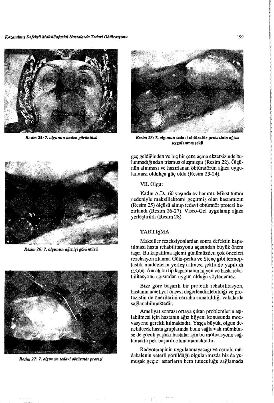 Ölçünün alınması ve hazırlanan obtüratörün ağıza uygulanması oldukça güç oldu (Resim 23-24). VTI. Olgu: Kadın A.D., 60 yaşında ev hanımı.