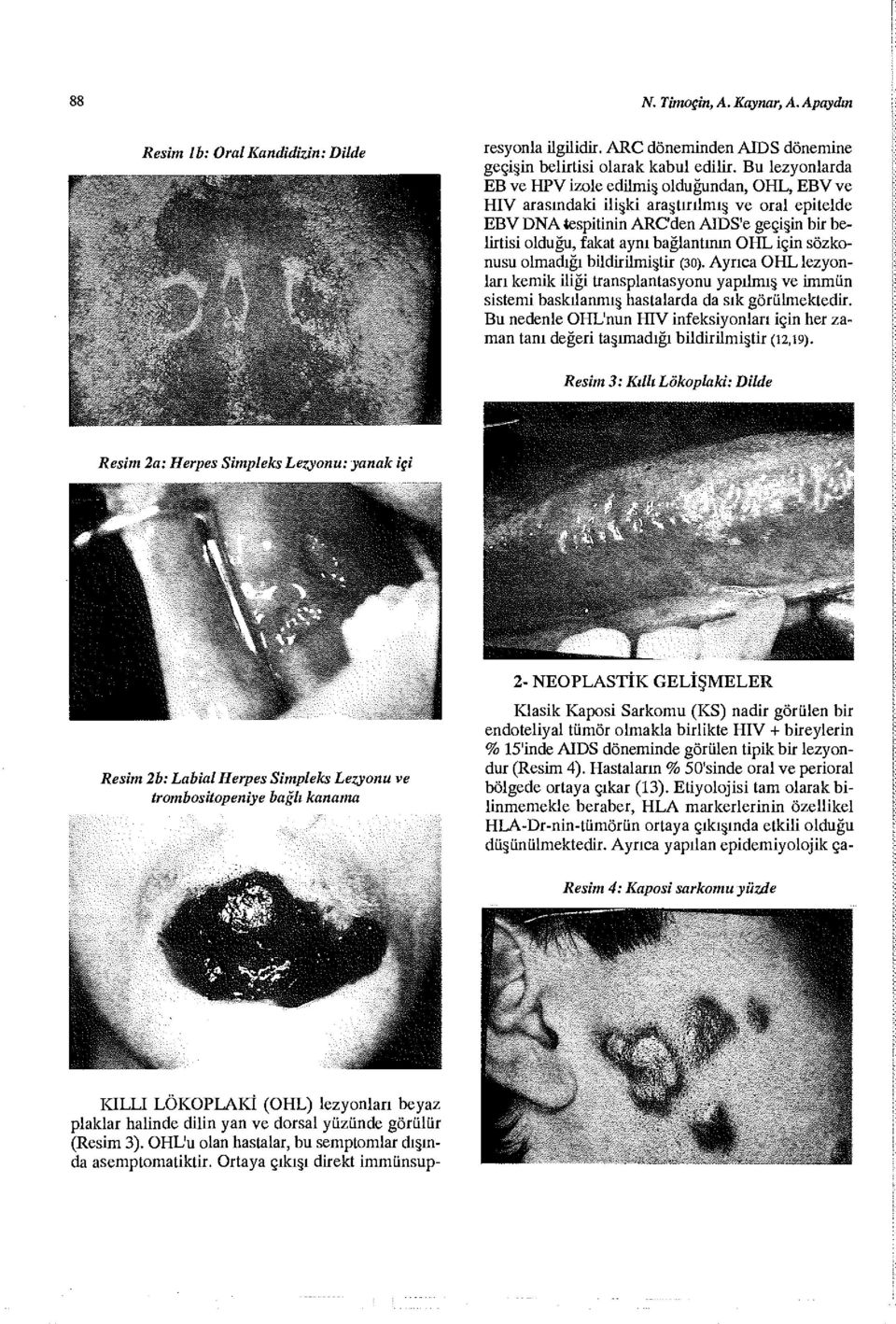 Bu lezyonlarda EB ve HPV izole edilmiş olduğundan, OHL, EBV ve HIV arasındaki ilişki araştırılmış ve oral epitelde EBV DNA tespitinin ARC'den AİDS'e geçişin bir belirtisi olduğu, fakat aynı