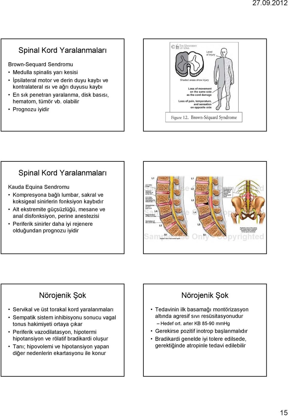olabilir Prognozu iyidir Spinal Kord Yaralanmaları Kauda Equina Sendromu Kompresyona bağlı lumbar, sakral ve koksigeal sinirlerin fonksiyon kaybıdır Alt ekstremite güçsüzlüğü, ü mesane ve anal