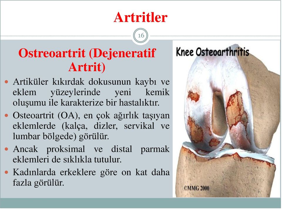 Osteoartrit (OA), en çok ağırlık taşıyan eklemlerde (kalça, dizler, servikal ve lumbar