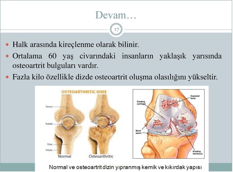 yarısında osteoartrit bulguları vardır.