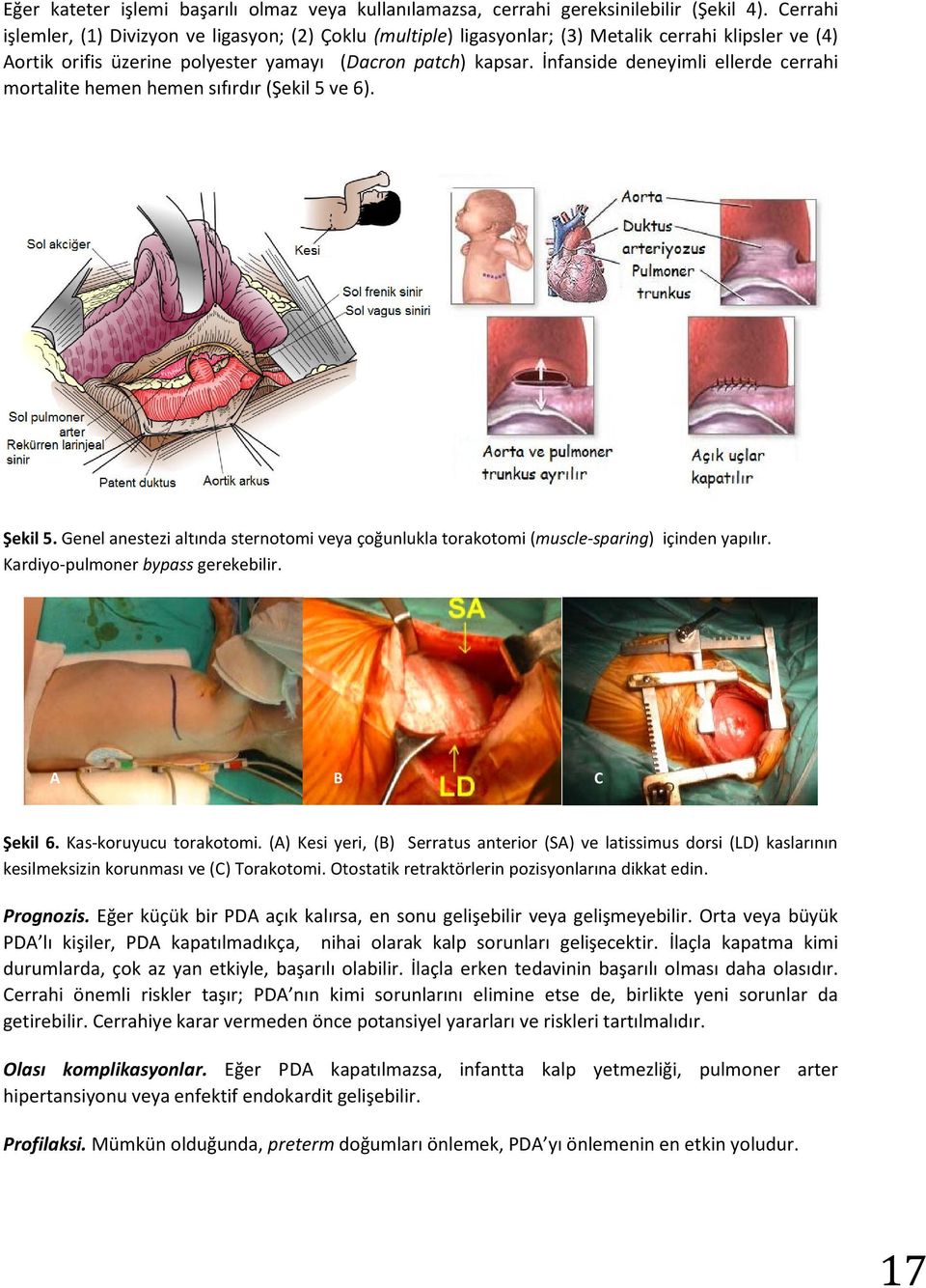 İnfanside deneyimli ellerde cerrahi mortalite hemen hemen sıfırdır (Şekil 5 ve 6). Şekil 5. Genel anestezi altında sternotomi veya çoğunlukla torakotomi (muscle-sparing) içinden yapılır.