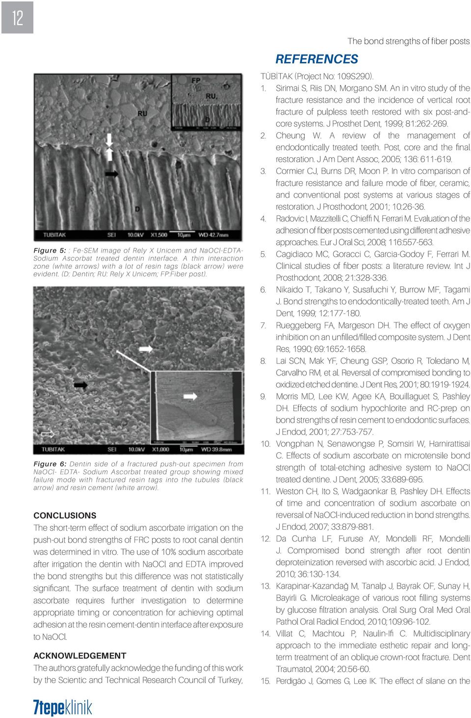 Figure 6: Dentin side of a fractured push-out specimen from NaOCl- EDTA- Sodium Ascorbat treated group showing mixed failure mode with fractured resin tags into the tubules (black arrow) and resin