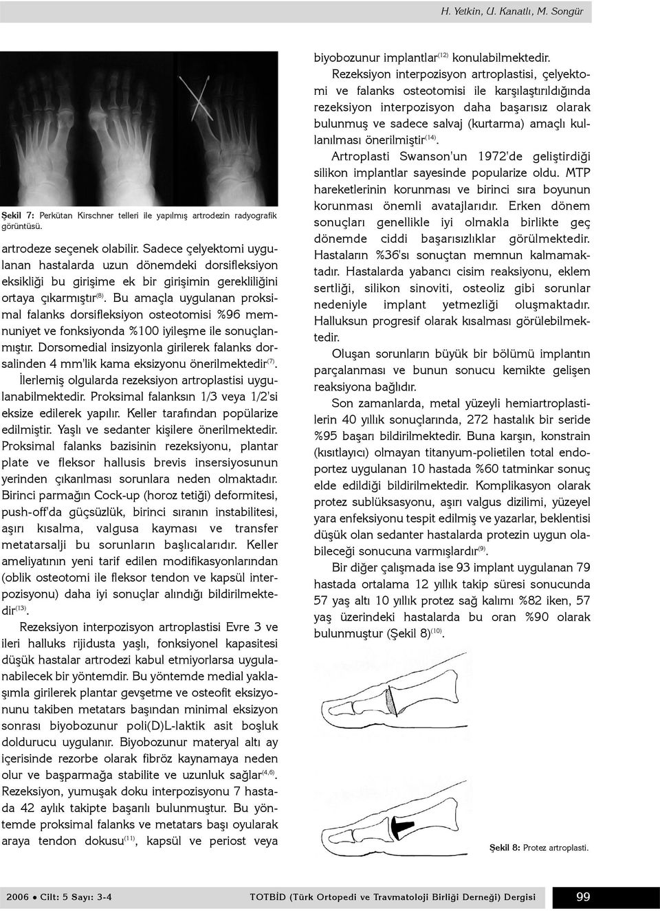 Bu amaçla uygulanan proksimal falanks dorsifleksiyon osteotomisi %96 memnuniyet ve fonksiyonda %100 iyileþme ile sonuçlanmýþtýr.