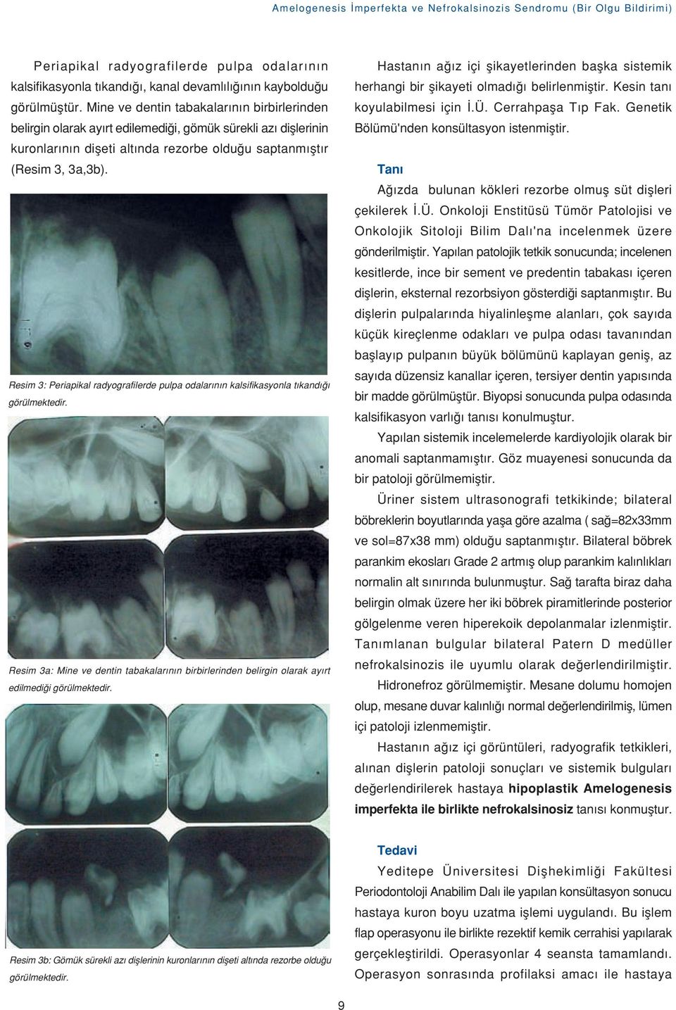 Resim 3: Periapikal radyografilerde pulpa odalar n n kalsifikasyonla t kand görülmektedir. Resim 3a: Mine ve dentin tabakalar n n birbirlerinden belirgin olarak ay rt edilmedi i görülmektedir.