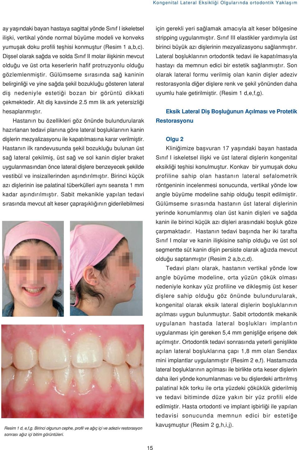 Gülümseme s ras nda sa kaninin belirginli i ve yine sa da flekil bozuklu u gösteren lateral difl nedeniyle esteti i bozan bir görüntü dikkati çekmektedir. Alt difl kavsinde 2.