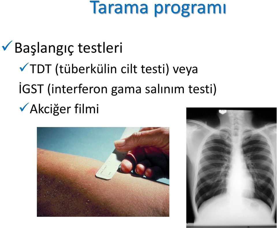 testi) veya İGST (interferon