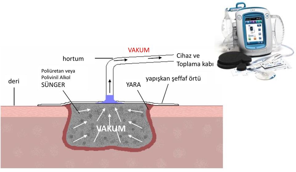 VAKUM YARA Cihaz ve Toplama