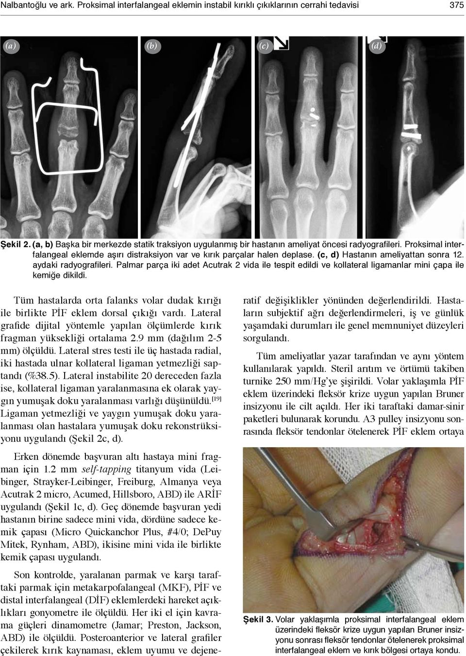 (c, d) Hastanın ameliyattan sonra 12. aydaki radyografileri. Palmar parça iki adet Acutrak 2 vida ile tespit edildi ve kollateral ligamanlar mini çapa ile kemiğe dikildi.