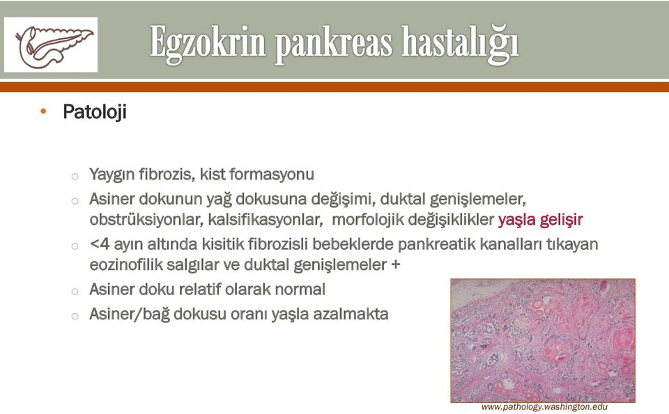 altında kisitik fibrozisli bebeklerde pankreatik kanalları tıkayan eozinofilik salgılar ve duktal