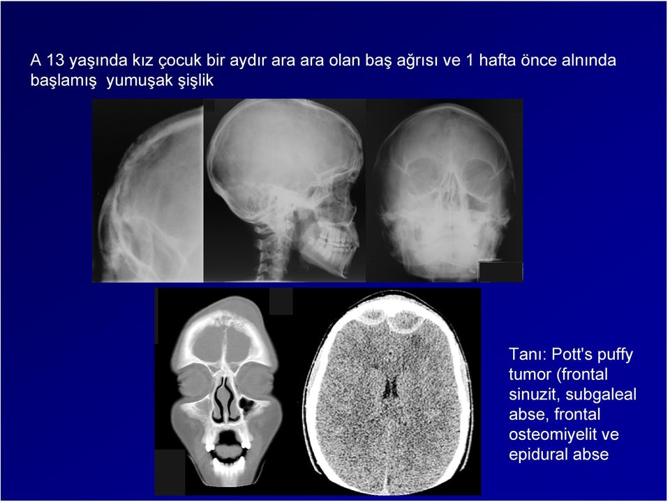 şişlik Tanı: Pott's puffy tumor (frontal sinuzit,