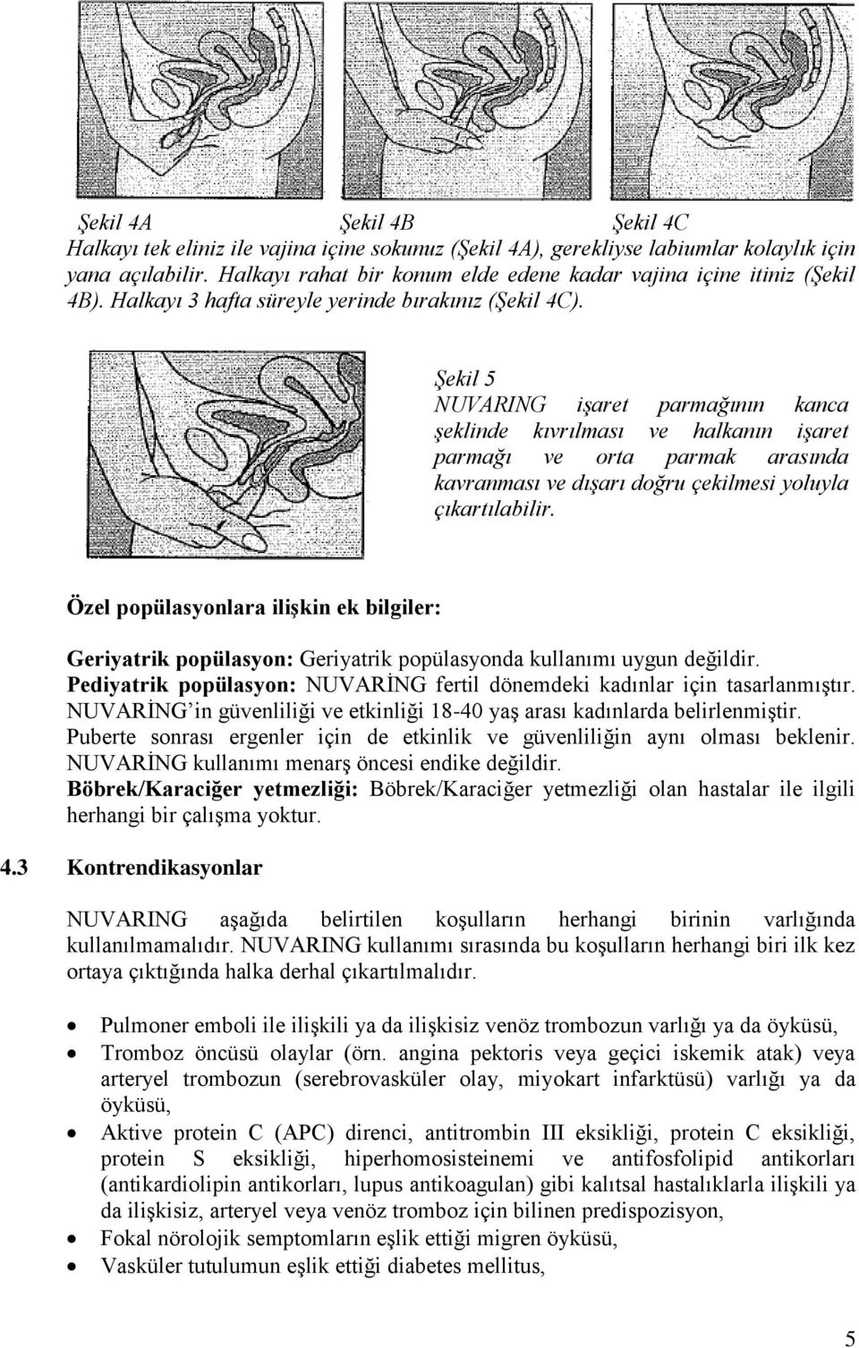 Şekil 5 NUVARING işaret parmağının kanca şeklinde kıvrılması ve halkanın işaret parmağı ve orta parmak arasında kavranması ve dışarı doğru çekilmesi yoluyla çıkartılabilir.