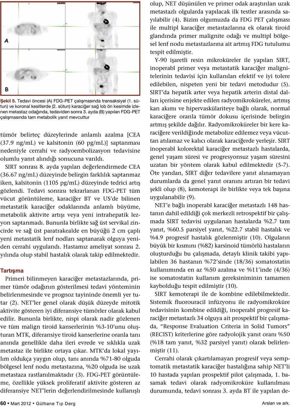 9 ng/ml) ve kalsitonin (60 pg/ml)] saptanması nedeniyle cerrahi ve radyoembolizasyon tedavisine olumlu yanıt alındığı sonucuna varıldı. SIRT sonrası 8. ayda yapılan değerlendirmede CEA (36.