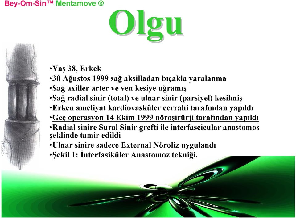 operasyon 14 Ekim 1999 nöroşirürji tarafından yapıldı Radial sinire Sural Sinir grefti ile interfascicular