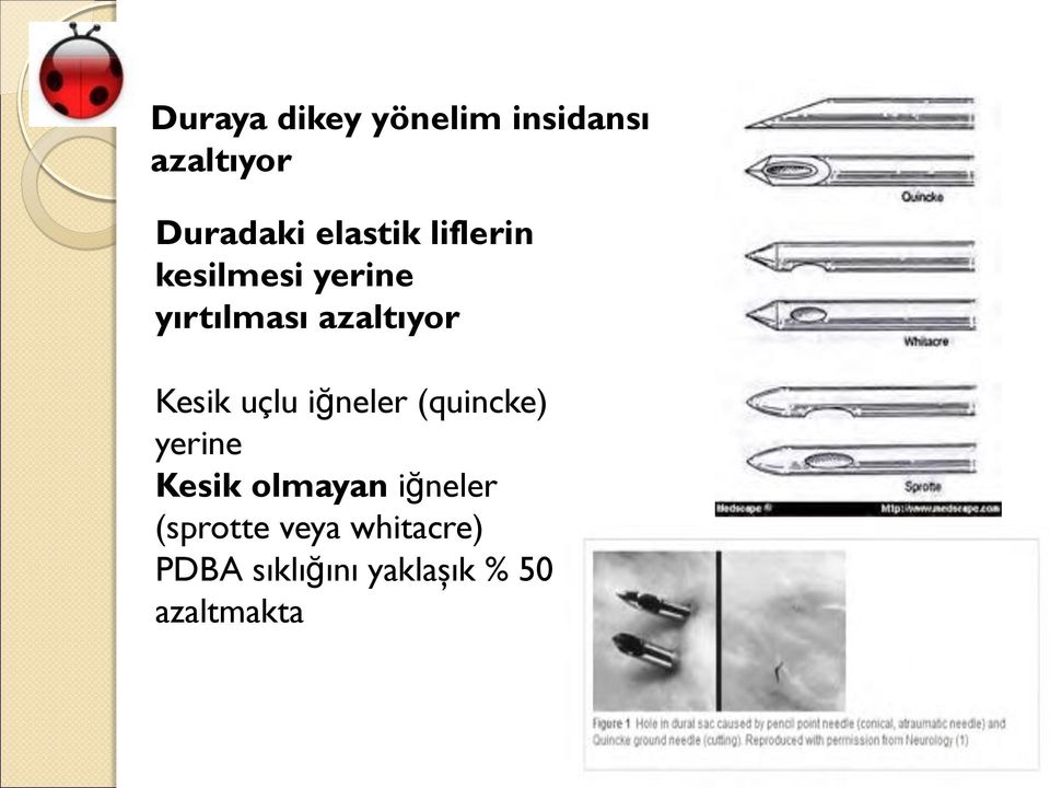 Kesik uçlu iğneler (quincke) yerine Kesik olmayan