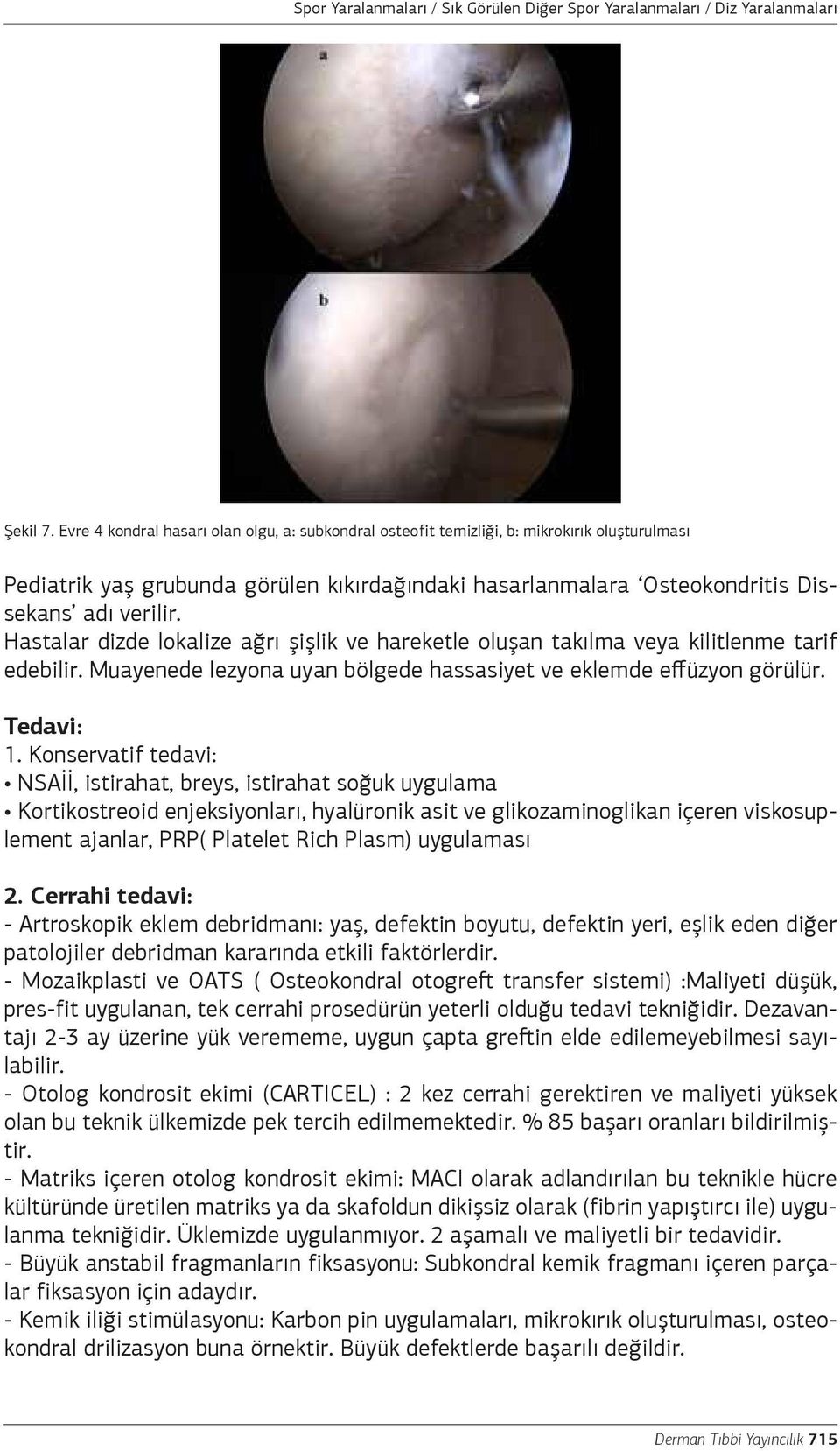 Hastalar dizde lokalize ağrı şişlik ve hareketle oluşan takılma veya kilitlenme tarif edebilir. Muayenede lezyona uyan bölgede hassasiyet ve eklemde effüzyon görülür. Tedavi: 1.