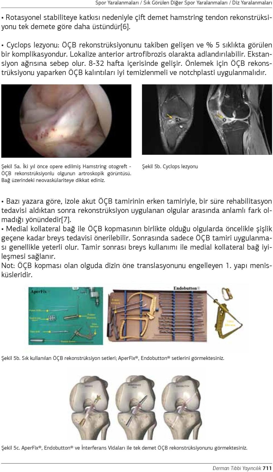 8-32 hafta içerisinde gelişir. Önlemek için ÖÇB rekonstrüksiyonu yaparken ÖÇB kalıntıları iyi temizlenmeli ve notchplasti uygulanmalıdır. Şekil 5a.