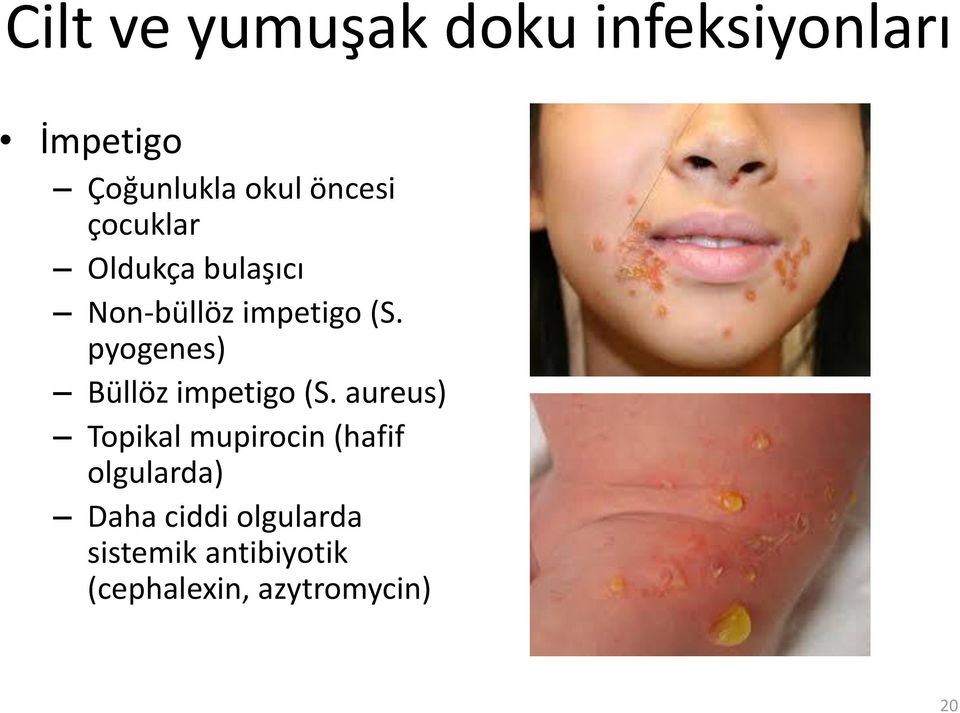 pyogenes) Büllöz impetigo (S.