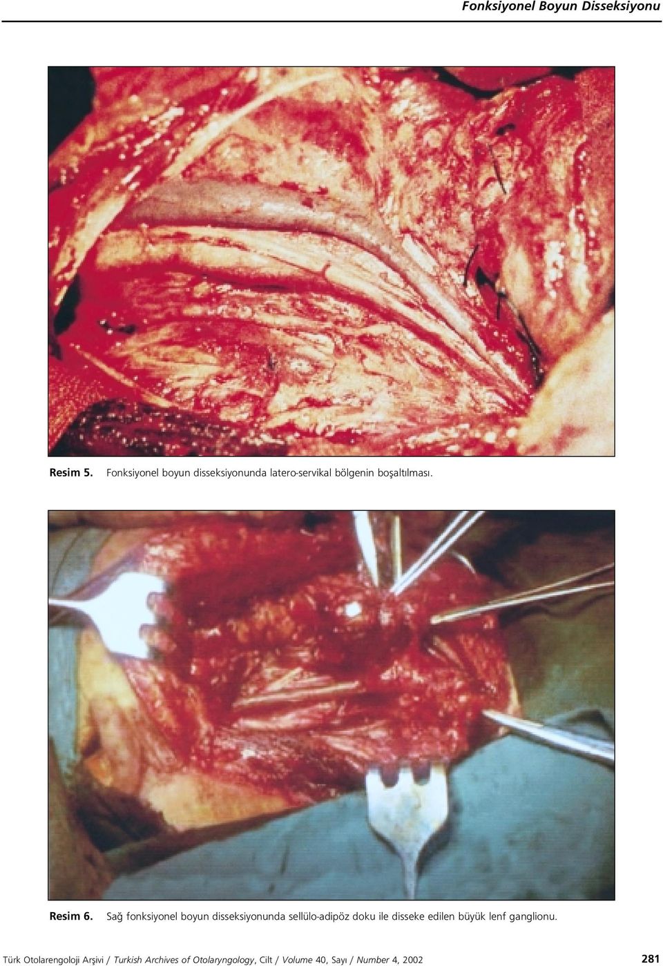 Sa fonksiyonel boyun disseksiyonunda sellülo-adipöz doku ile disseke edilen büyük