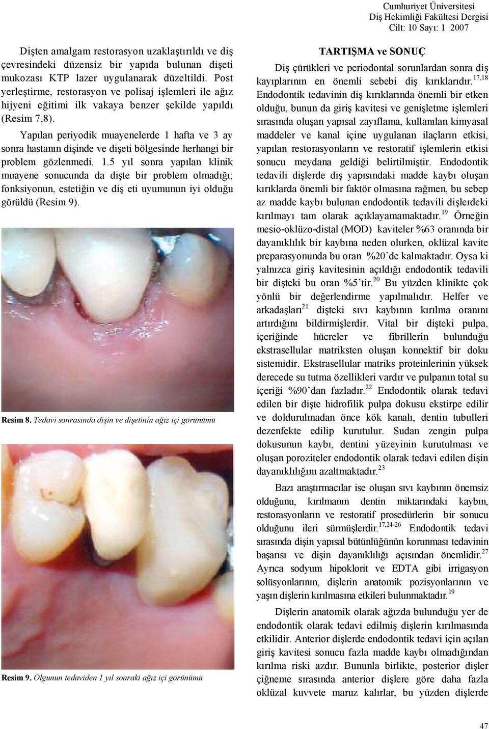 Yaplan periyodik muayenelerde 1 hafta ve 3 ay sonra hastann diinde ve dieti bölgesinde herhangi bir problem gözlenmedi. 1.5 yl sonra yaplan klinik muayene sonucunda da dite bir problem olmad; fonksiyonun, estetiin ve di eti uyumunun iyi olduu görüldü (Resim 9).