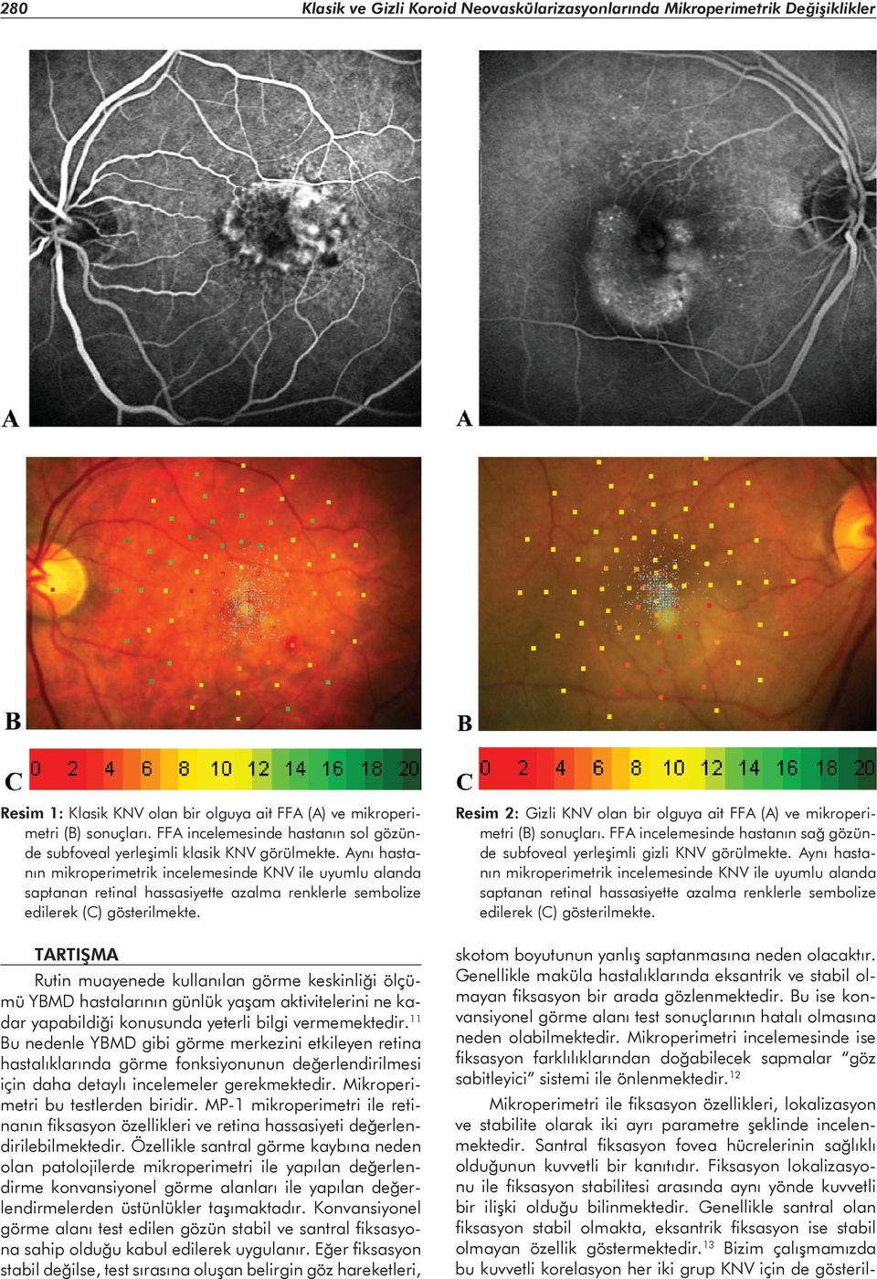 Aynı hastanın mikroperimetrik incelemesinde ile uyumlu alanda saptanan retinal hassasiyette azalma renklerle sembolize edilerek (C) gösterilmekte.