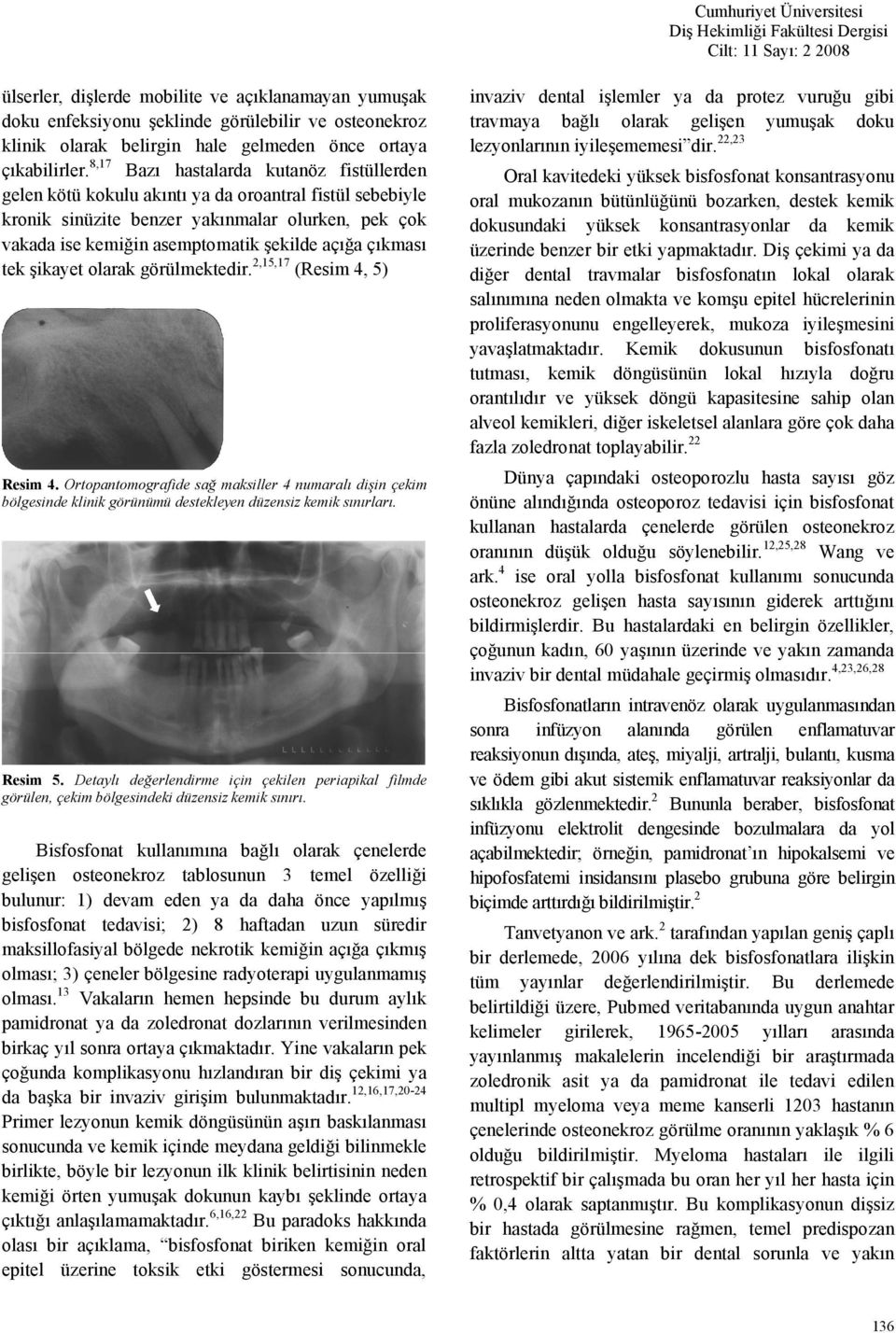 çıkması tek şikayet olarak görülmektedir. 2,15,17 (Resim 4, 5) Resim 4. Ortopantomografide sağ maksiller 4 numaralı dişin çekim bölgesinde klinik görünümü destekleyen düzensiz kemik sınırları.