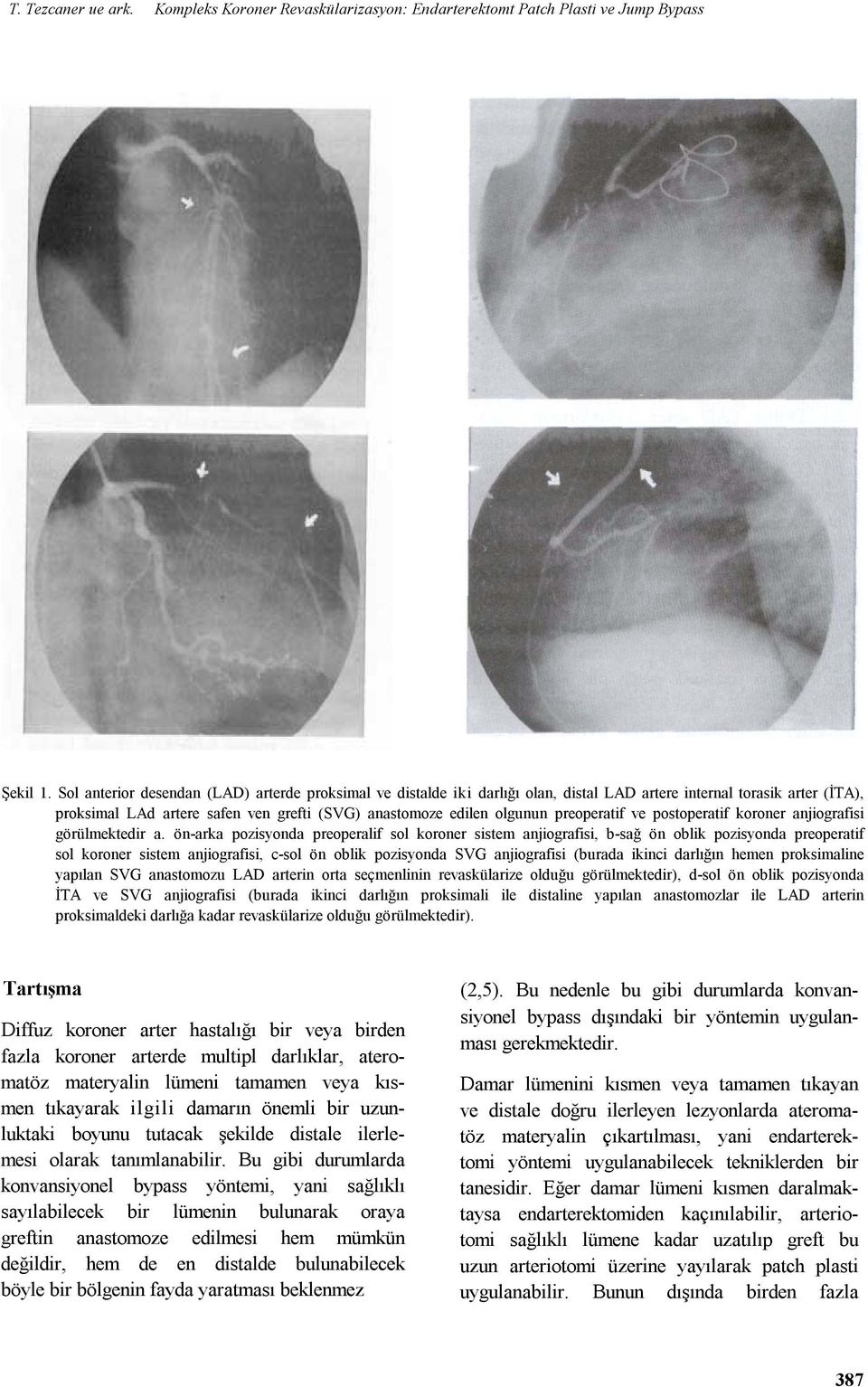 postoperatif koroner anjiografisi görümektedir a.