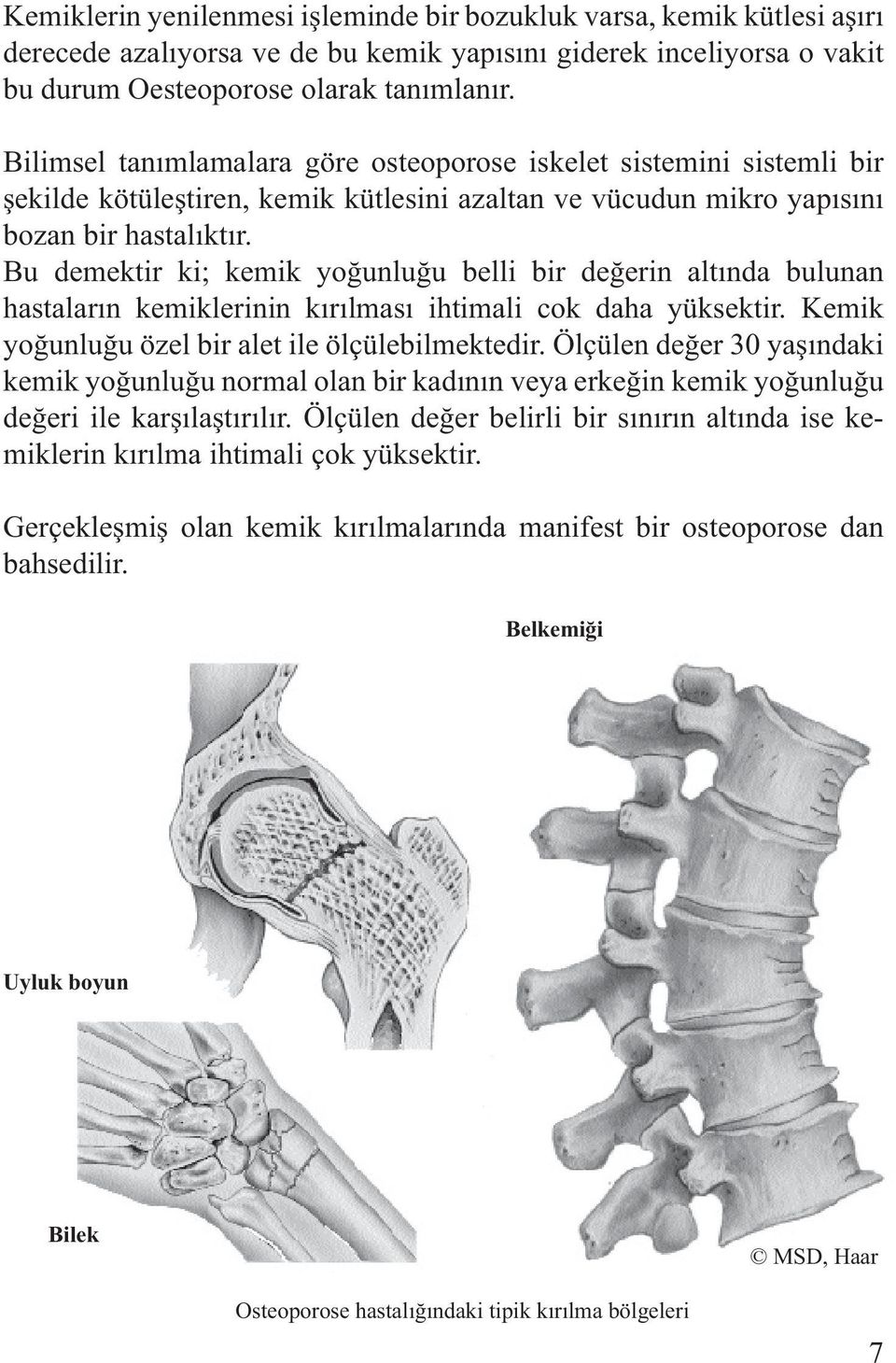 Bu demektir ki; kemik yoğunluğu belli bir değerin altında bulunan hastaların kemiklerinin kırılması ihtimali cok daha yüksektir. Kemik yoğunluğu özel bir alet ile ölçülebilmektedir.