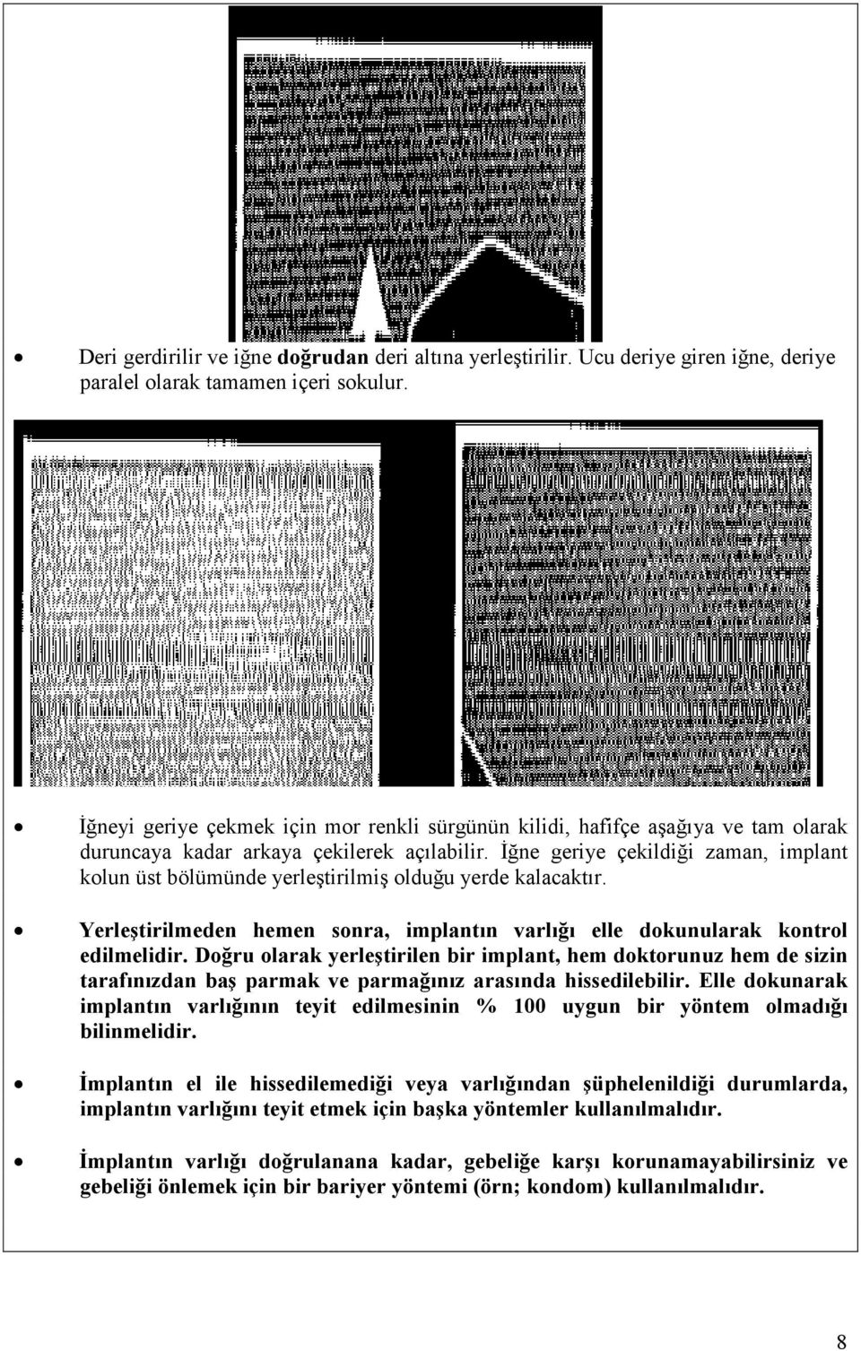 Đğne geriye çekildiği zaman, implant kolun üst bölümünde yerleştirilmiş olduğu yerde kalacaktır. Yerleştirilmeden hemen sonra, implantın varlığı elle dokunularak kontrol edilmelidir.