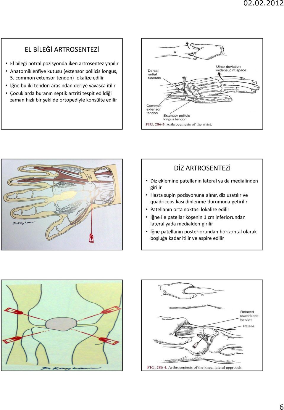 ortopediyle konsülte edilir DİZ ARTROSENTEZİ Diz eklemine patellanın lateral ya da medialinden girilir Hasta supin pozisyonuna alınır, diz uzatılır ve quadriceps kası
