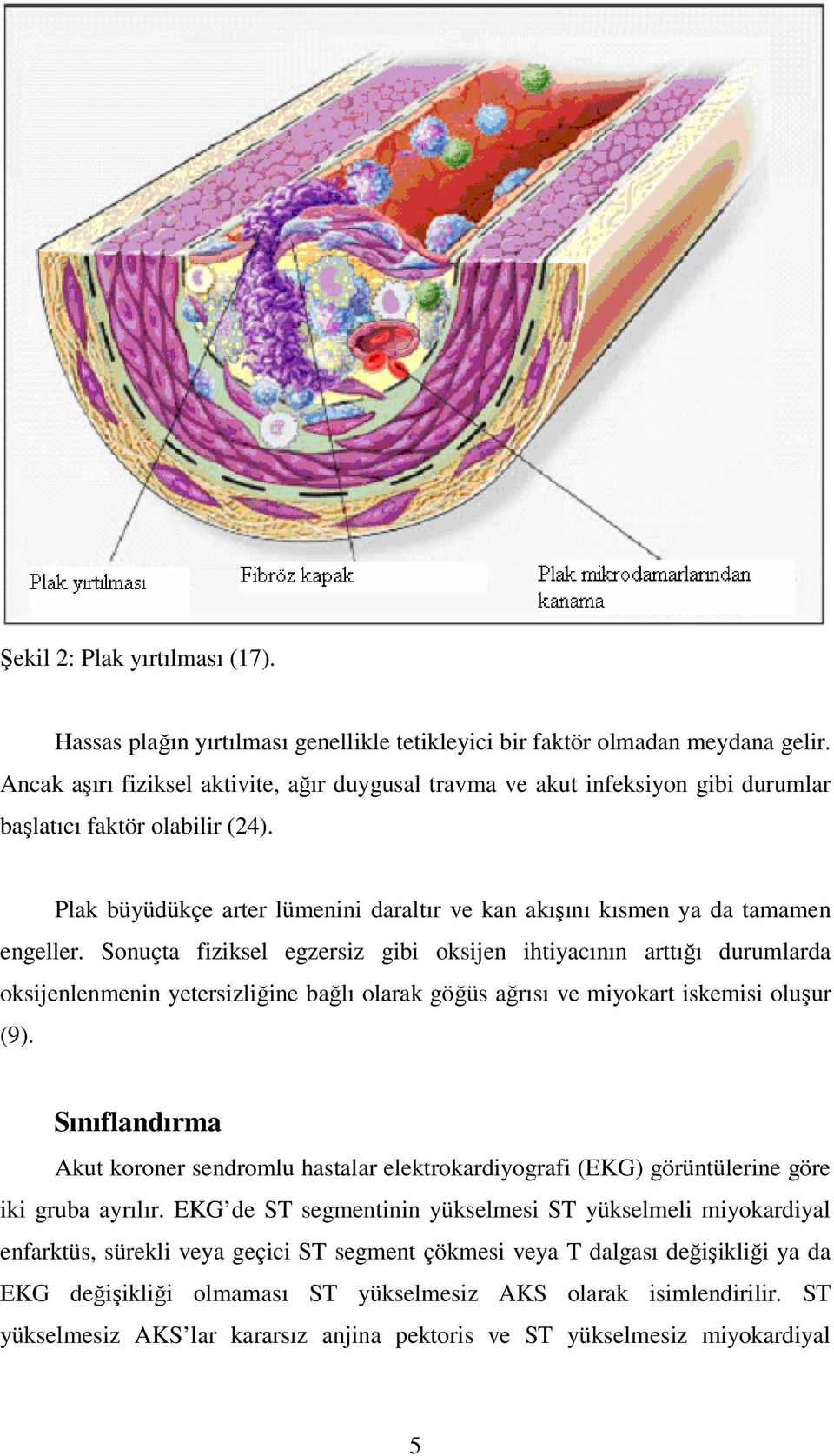 Plak büyüdükçe arter lümenini daraltır ve kan akışını kısmen ya da tamamen engeller.