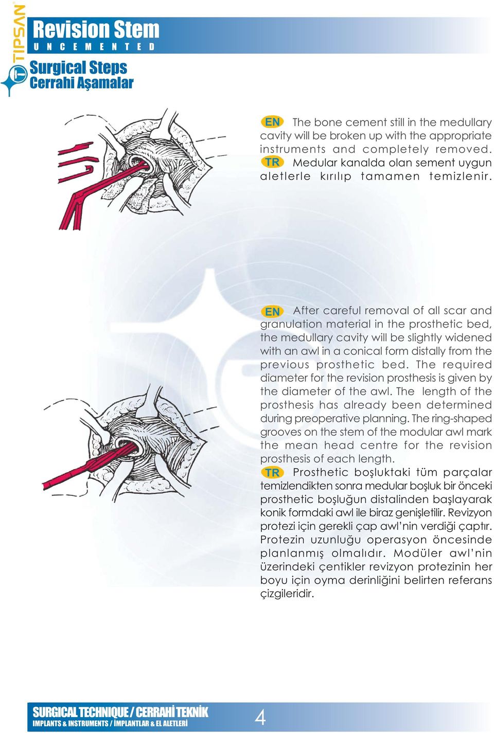 After careful removal of all scar and granulation material in the prosthetic bed, the medullary cavity will be slightly widened with an awl in a conical form distally from the previous prosthetic bed.