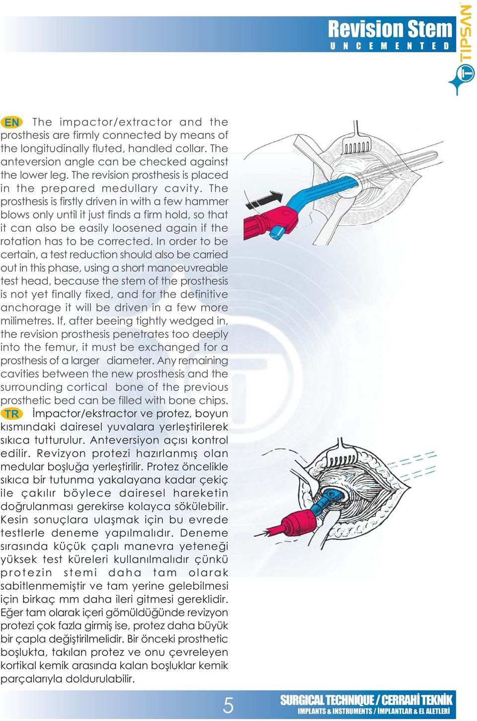 The prosthesis is firstly driven in with a few hammer blows only until it just finds a firm hold, so that it can also be easily loosened again if the rotation has to be corrected.