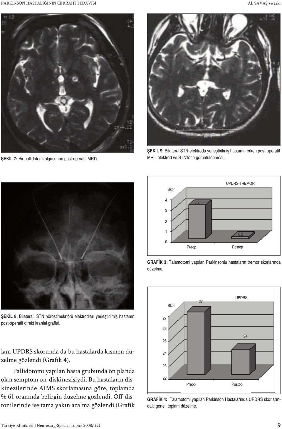 2 Postop GRAFİK 3: Talamotomi yapılan Parkinsonlu hastaların tremor skorlarında düzelme.