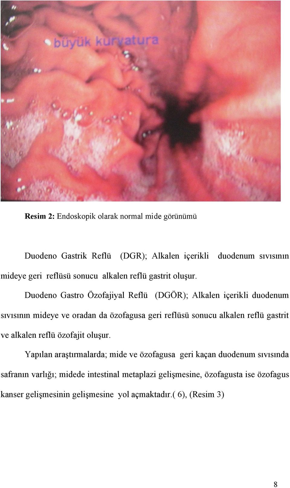Duodeno Gastro Özofajiyal Reflü (DGÖR); Alkalen içerikli duodenum sıvısının mideye ve oradan da özofagusa geri reflüsü sonucu alkalen reflü