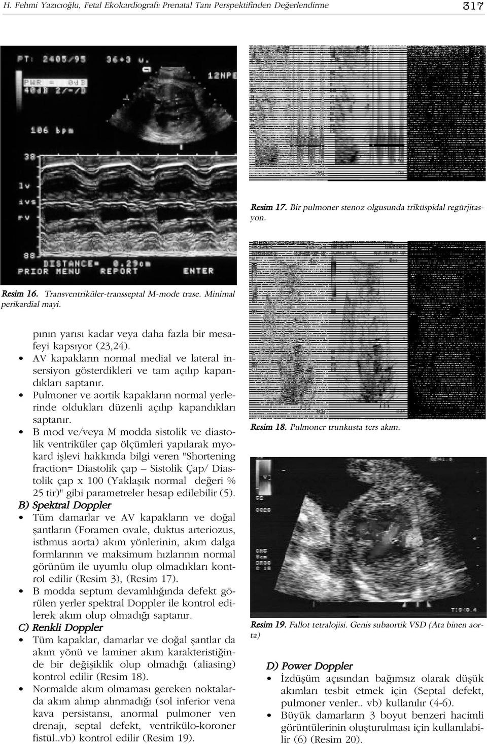 AV kapaklar n normal medial ve lateral insersiyon gösterdikleri ve tam aç l p kapand klar saptan r. Pulmoner ve aortik kapaklar n normal yerlerinde olduklar düzenli aç l p kapand klar saptan r.