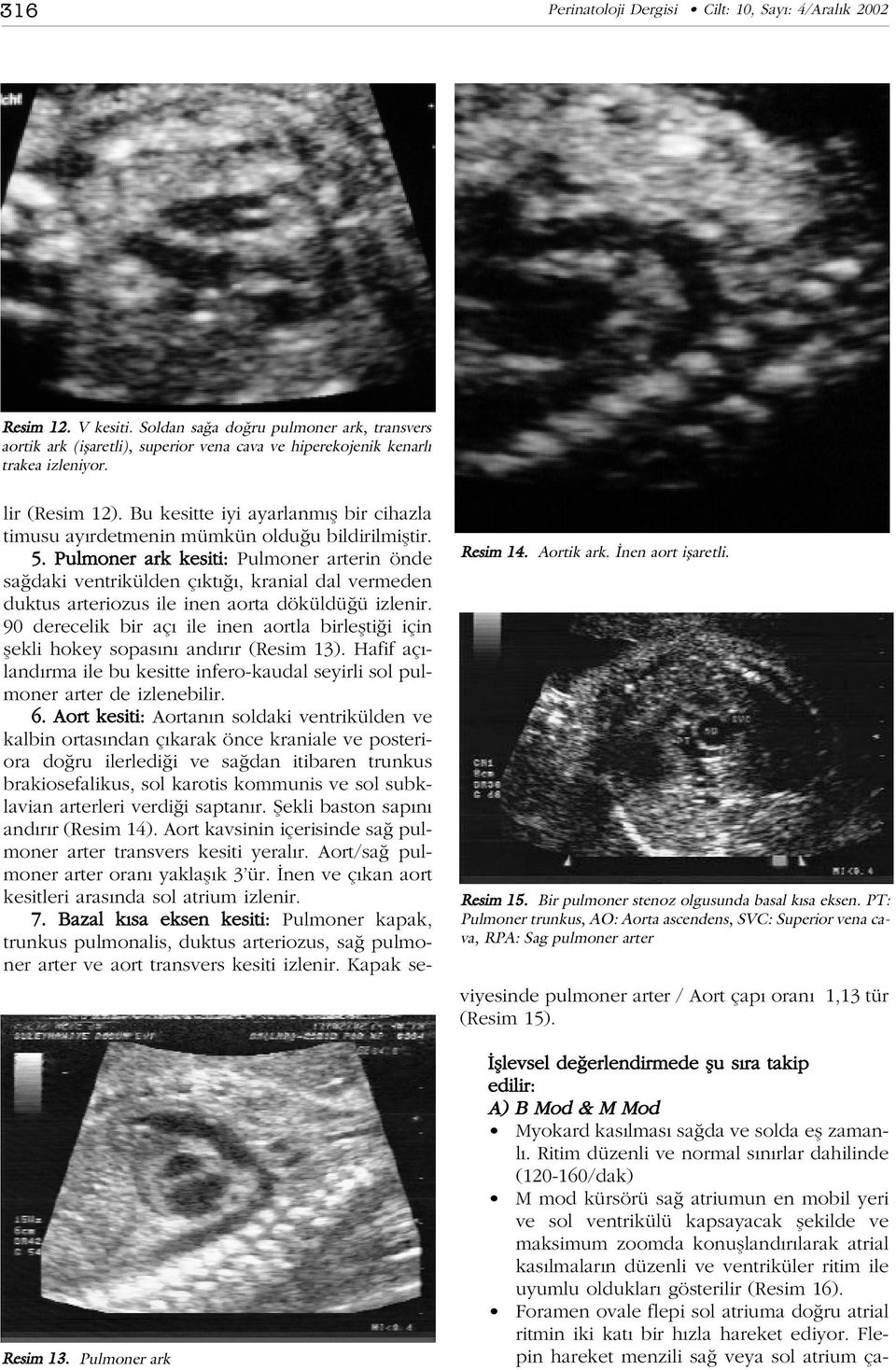 Resim 15. Bir pulmoner stenoz olgusunda basal k sa eksen. PT: Pulmoner trunkus, AO: Aorta ascendens, SVC: Superior vena cava, RPA: Sag pulmoner arter lir (Resim 12).