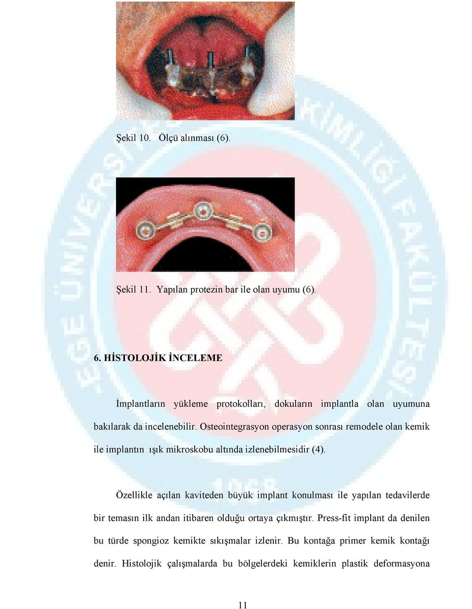 Osteointegrasyon operasyon sonrası remodele olan kemik ile implantın ışık mikroskobu altında izlenebilmesidir (4).