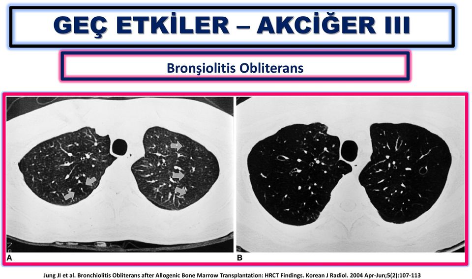 Bronchiolitis Obliterans after Allogenic Bone