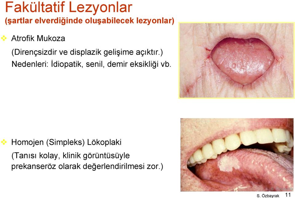 ) Nedenleri: İdiopatik, senil, demir eksikliği vb.