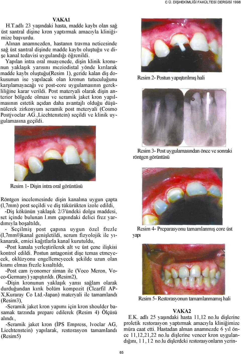 Yapılan intra oral muayenede, dişin klinik kronunun yaklaşık yarısını meziodistal yönde kırılarak madde kaybı oluştuğu(resim 1), geride kalan diş dokusunun ise yapılacak olan kronun tutuculuğunu