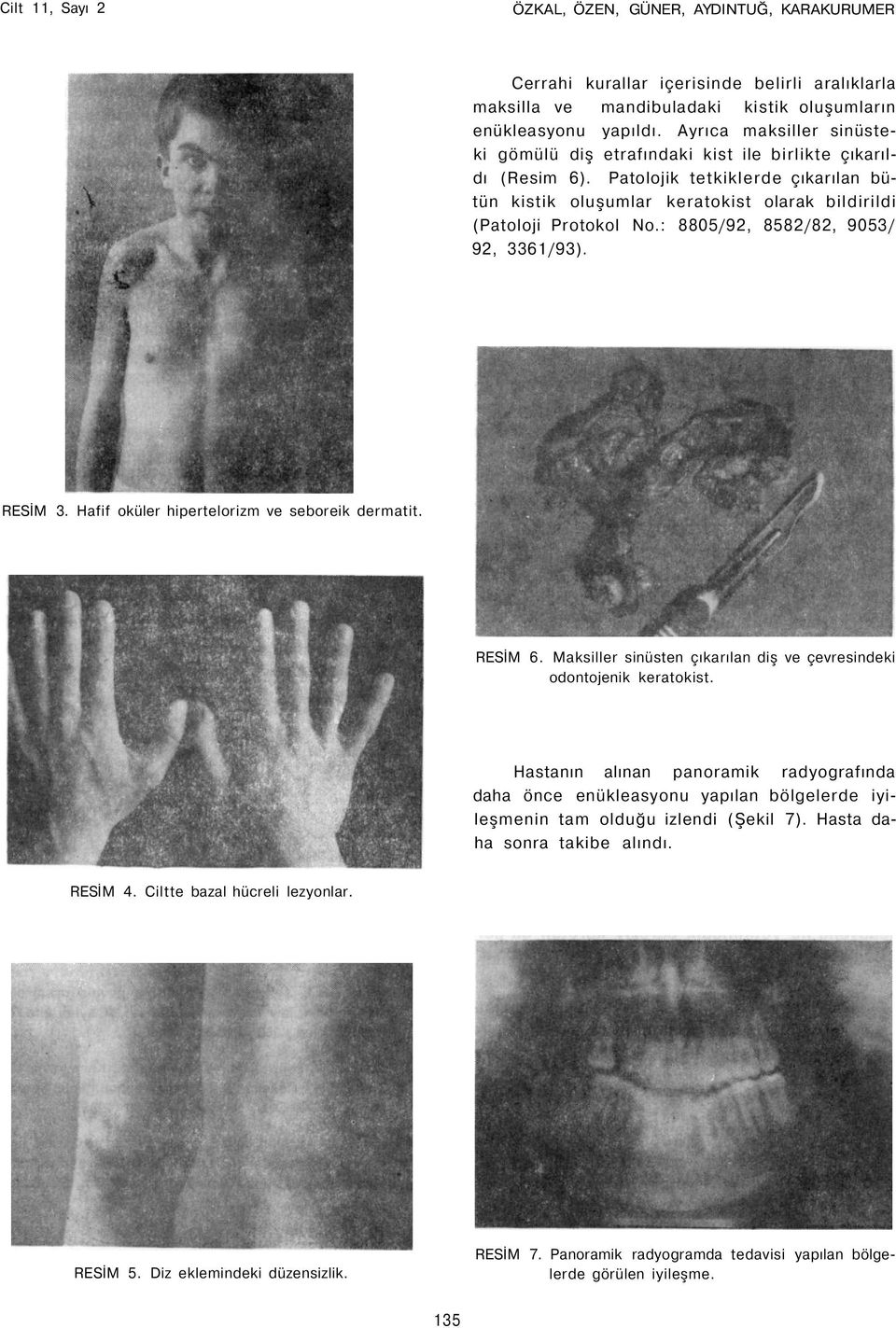 : 8805/92, 8582/82, 9053/ 92, 3361/93). RESİM 3. Hafif oküler hipertelorizm ve seboreik dermatit. RESİM 6. Maksiller sinüsten çıkarılan diş ve çevresindeki odontojenik keratokist.