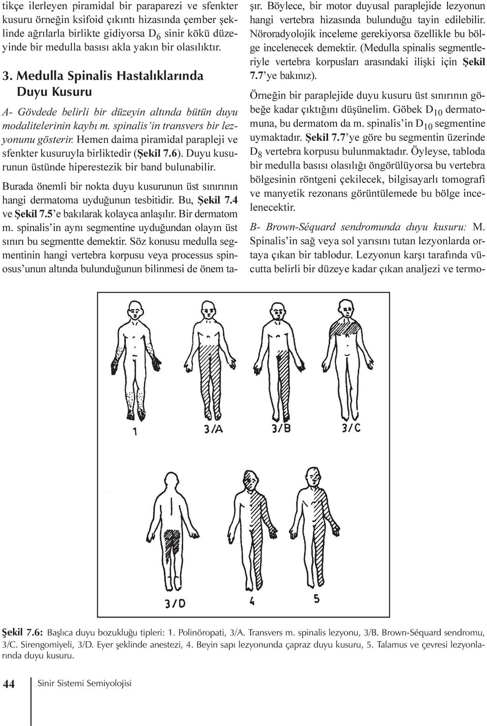 Hemen daima piramidal parapleji ve sfenkter kusuruyla birliktedir (Þekil 7.6). Duyu kusurunun üstünde hiperestezik bir band bulunabilir.